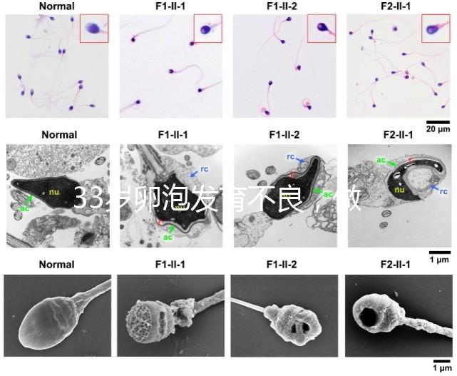 33歲卵泡發育不良，做試管黃體期促排方案失敗怎么辦？